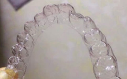 戴牙套作文(通用22篇)